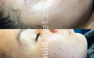 Acne behandelen met IMAGE Skincare peeling