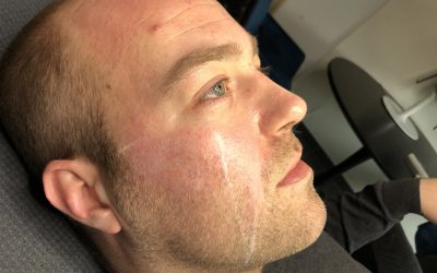 Ervaring: De TCA-peeling