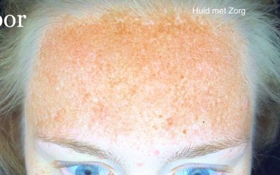 Resultaat: Spot Out behandeling tegen pigmentvlekken