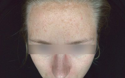 Resultaat pigment verminderen in het gelaat met de Spot Out Cream en TCA Peeling van Toskani