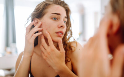 Wat is het verschil tussen acne en puistjes?